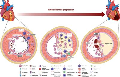 The Roles of Neutrophils Linking Periodontitis and Atherosclerotic Cardiovascular Diseases